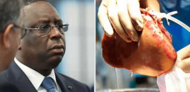 Transplantation rénale au Sénégal: Les grosses craintes du Président Macky Sall!