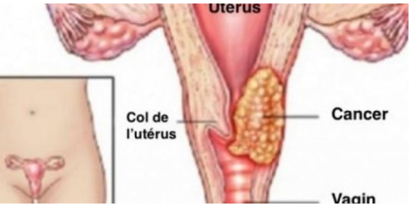 Cancer du col de l’utérus : 80 % de 2 500 cas meurent par an